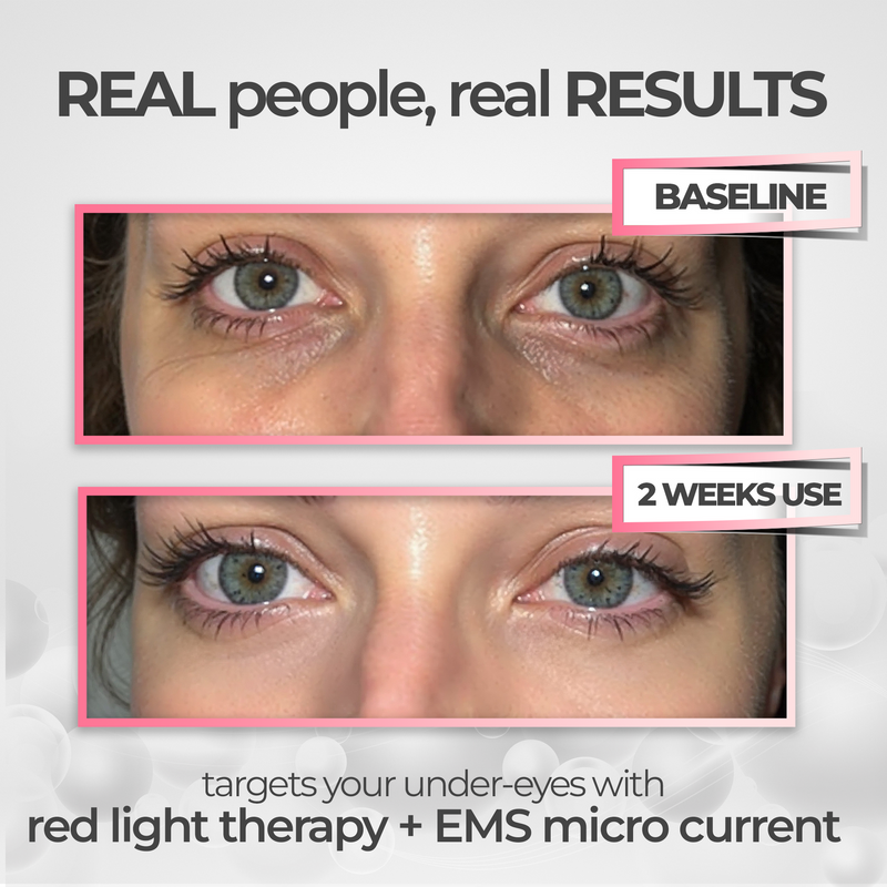 ParisEyes™ Under-Eye Red Light Therapy